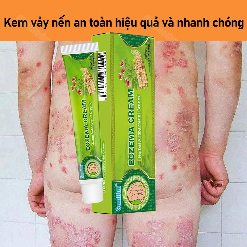 Kem bôi nấm ngứaKem chống ngứa bệnh chàm 20g viêm da cơ địa Kem bệnh vẩy nến kem dưỡng da chàm Kem kháng khuẩn thảo mộc,nấm da chân, mề đay, viêm da dị ứng,vảy nến, mề đay,viêm da tiết bã, viêm da dị ứng