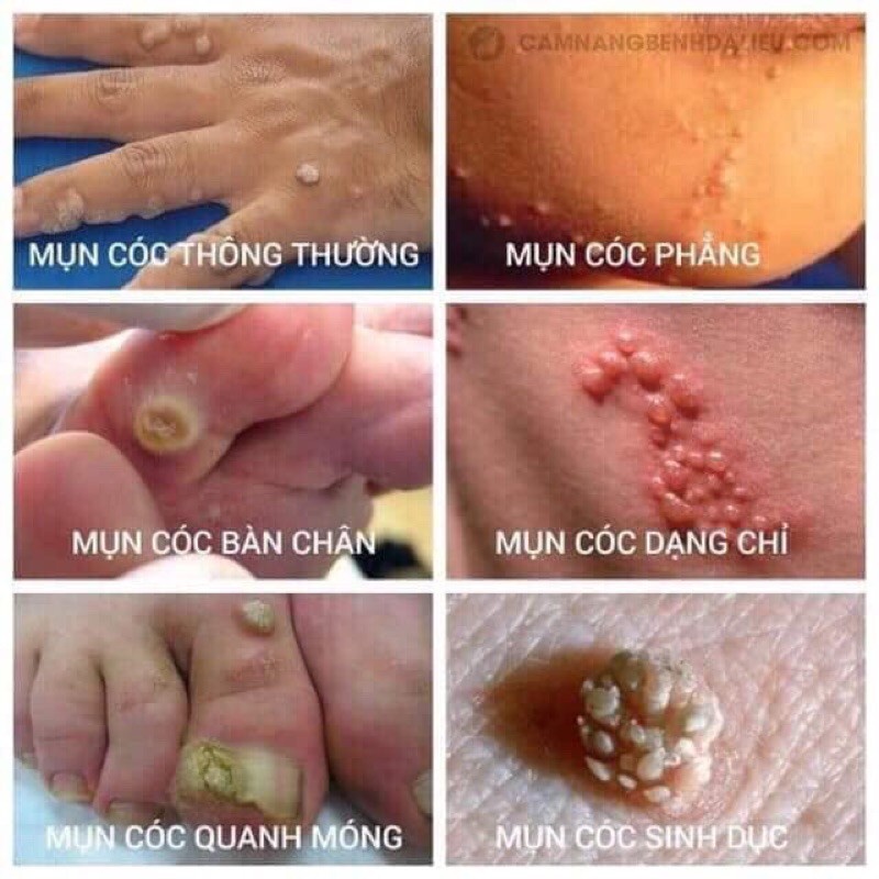 MỤN  CON CON THÁI LAN CHAI 15ML