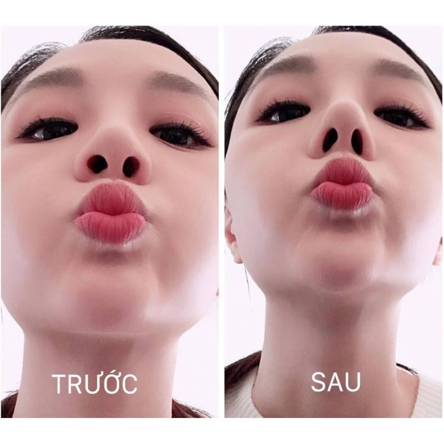Bộ dụng cụ nâng mũi 3D Hàn Quốc