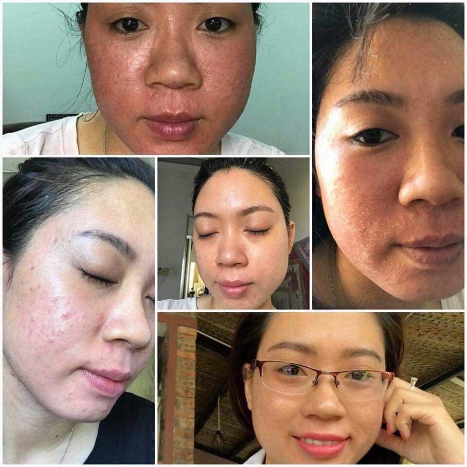 COMBO TÁI TẠO DA ( Tạm biệt mụn )
