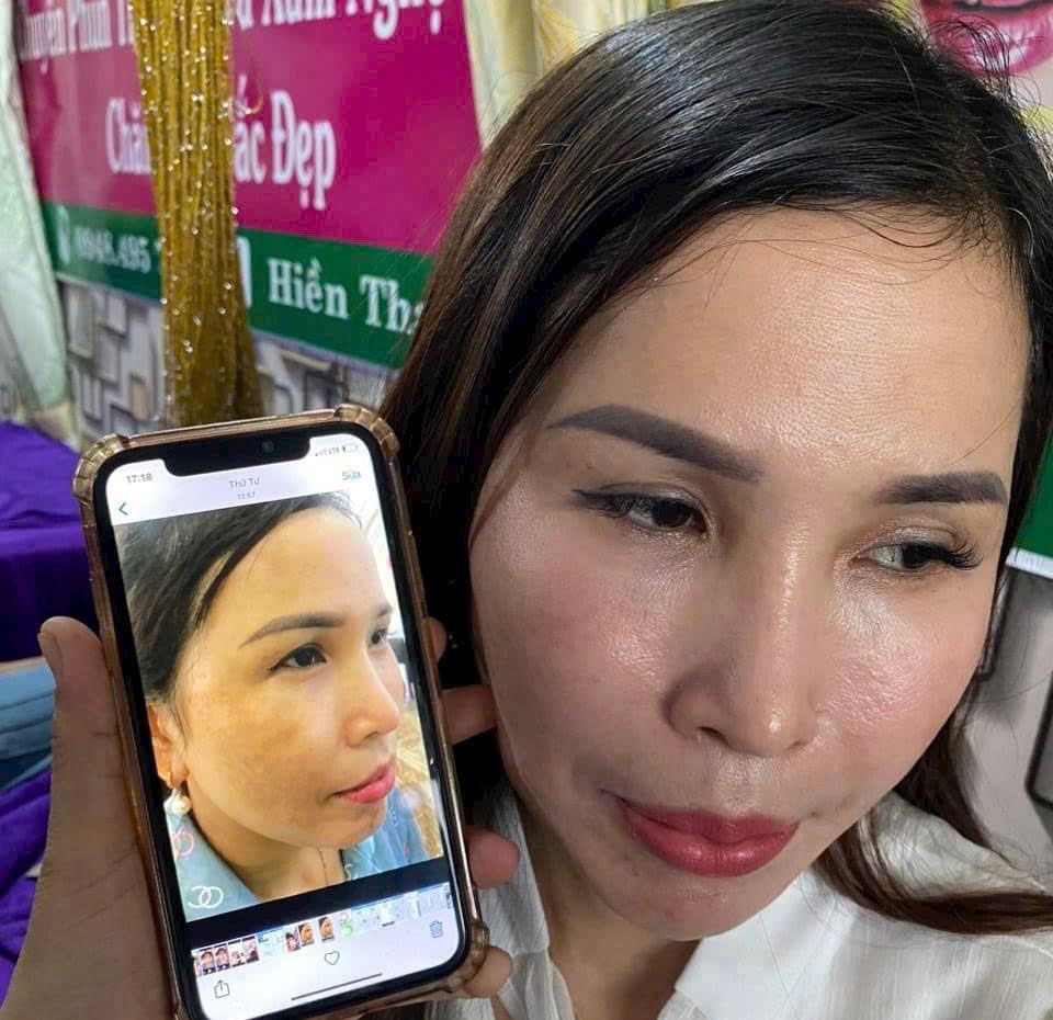 [Genuine] Yody Phuong Anh Skin Peeling Treatment Helps Even Skin Tone