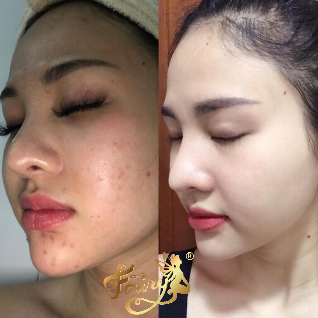 Kem mụn ngừa thâm Fairy 15gr
