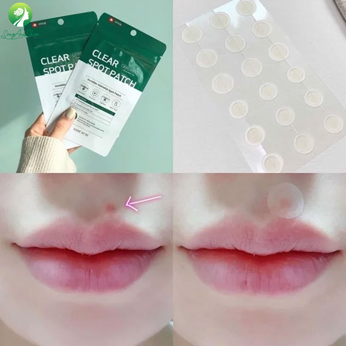 Miếng Dán Mụn Some By Mi Clear Spot Patch (gồm 18 miếng tròn)
