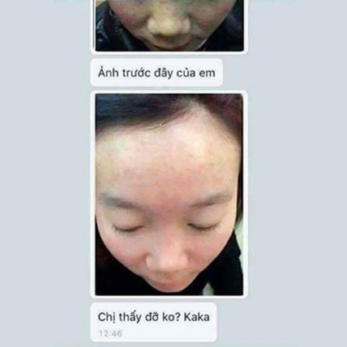 KEM MỤN MẸ KEN 30ml