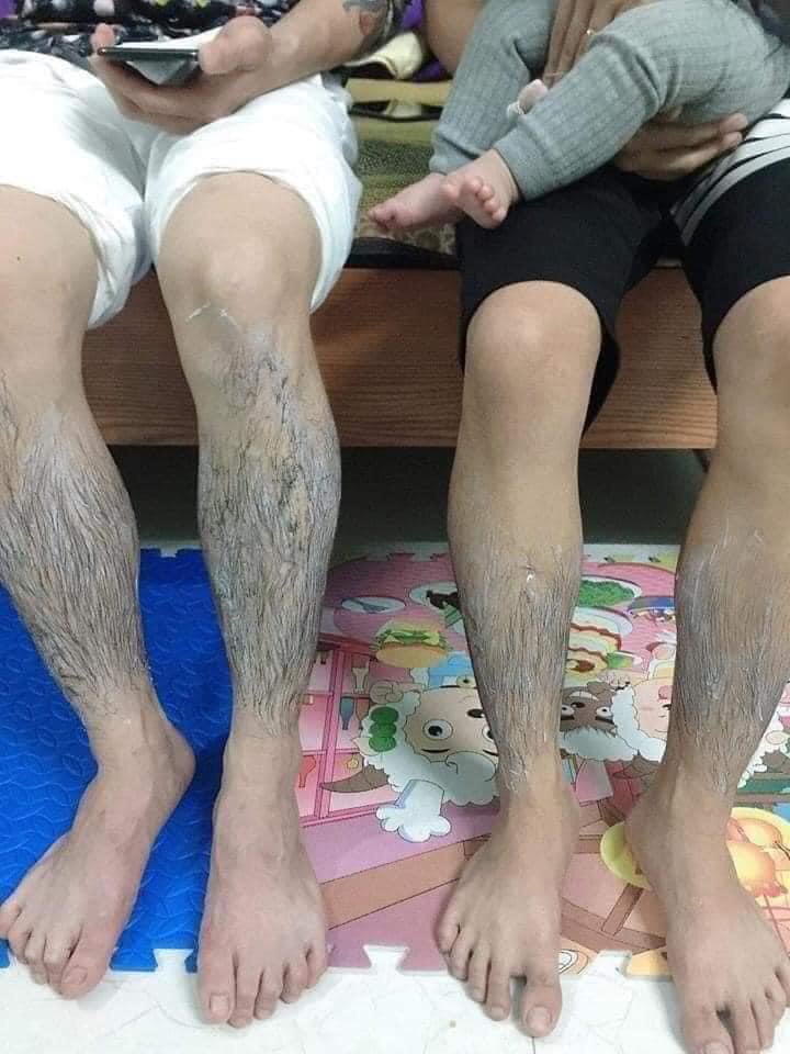 [HCM]Tẩy lông triệt lông perfect clean - tẩy lông Huyền phi