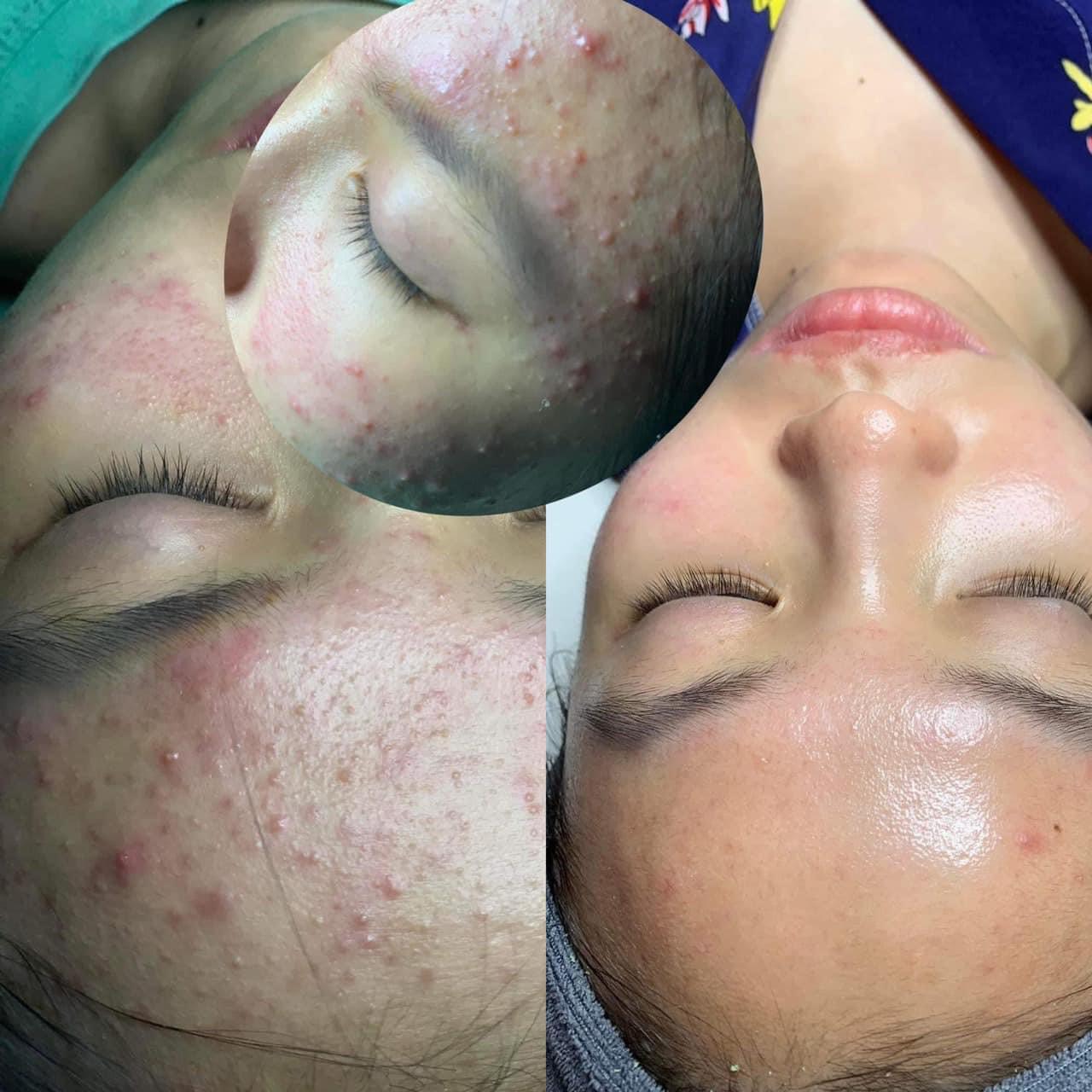 Bộ Đôi Serum mụn ANTI BLEMISH-ANTI ACNE 10+, Care 10+ ADA Group