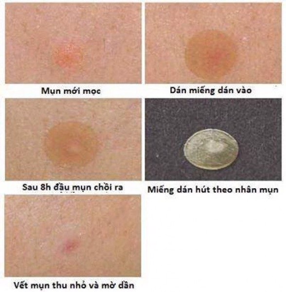 Miếng dán mụn Ciracle Red Spot Acne Pimple Path 24 Miếng