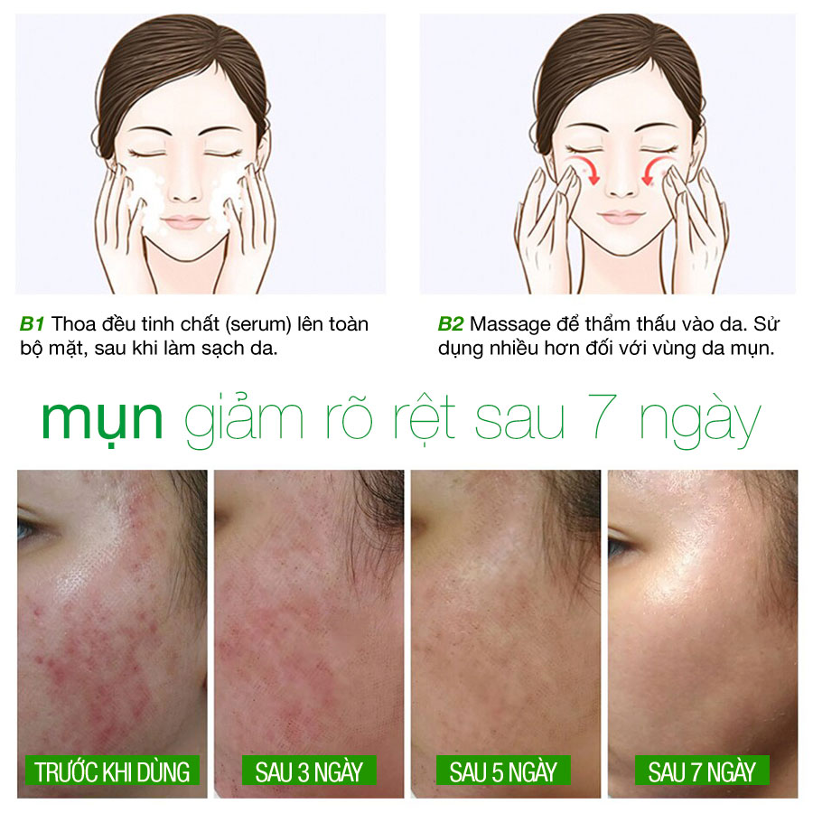 TẠM BIỆT MỤN BYE BYE BLEMISH for Acne LANGCE