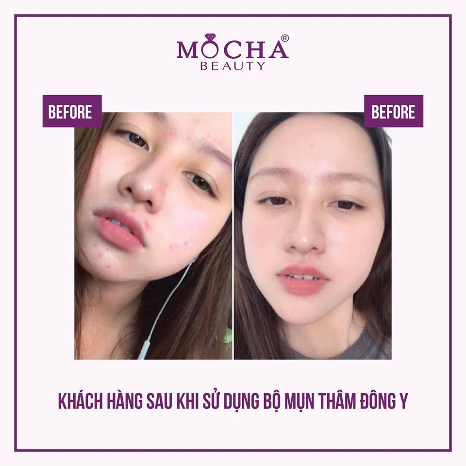 Kem Mụn - Bộ MỤN MOCHA 60gram gồm 2 hộp