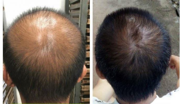 (TẶNG AZELAIC) - Dung Dịch Mọc Tóc Morr F10% (Minoxidil 10% Hàm Lượng Cao)