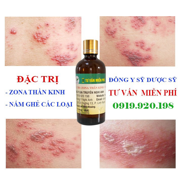 Zona thần kinh bằng thảo mộc - 01 chai