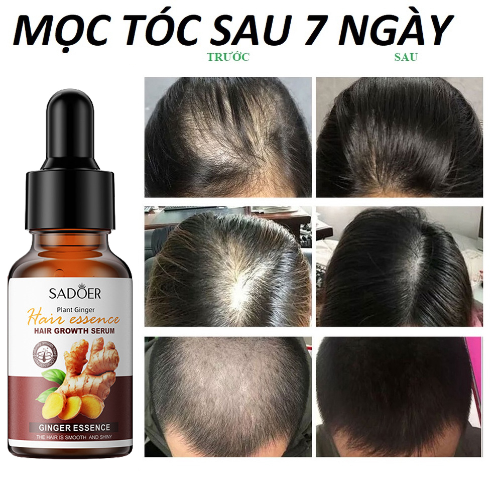 Thuốc mọc tóc serum kích mọc tóc chống rụng tóc kích mọc tóc chăm sóc tóc 30ml  kích thích mọc tóc nhanh làm dày