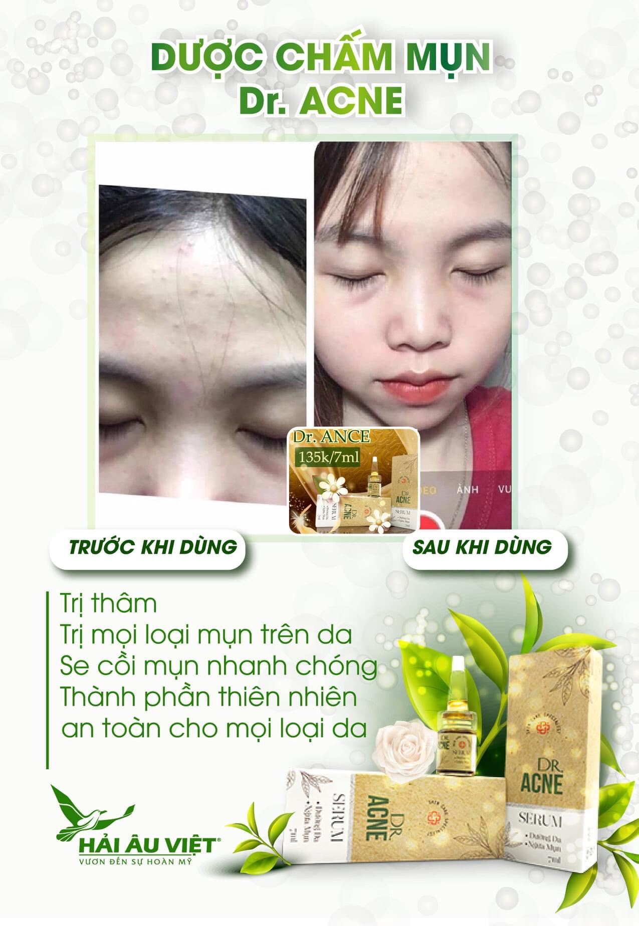 Chấm mụn 2 lớp xẹp mụn sau 4h