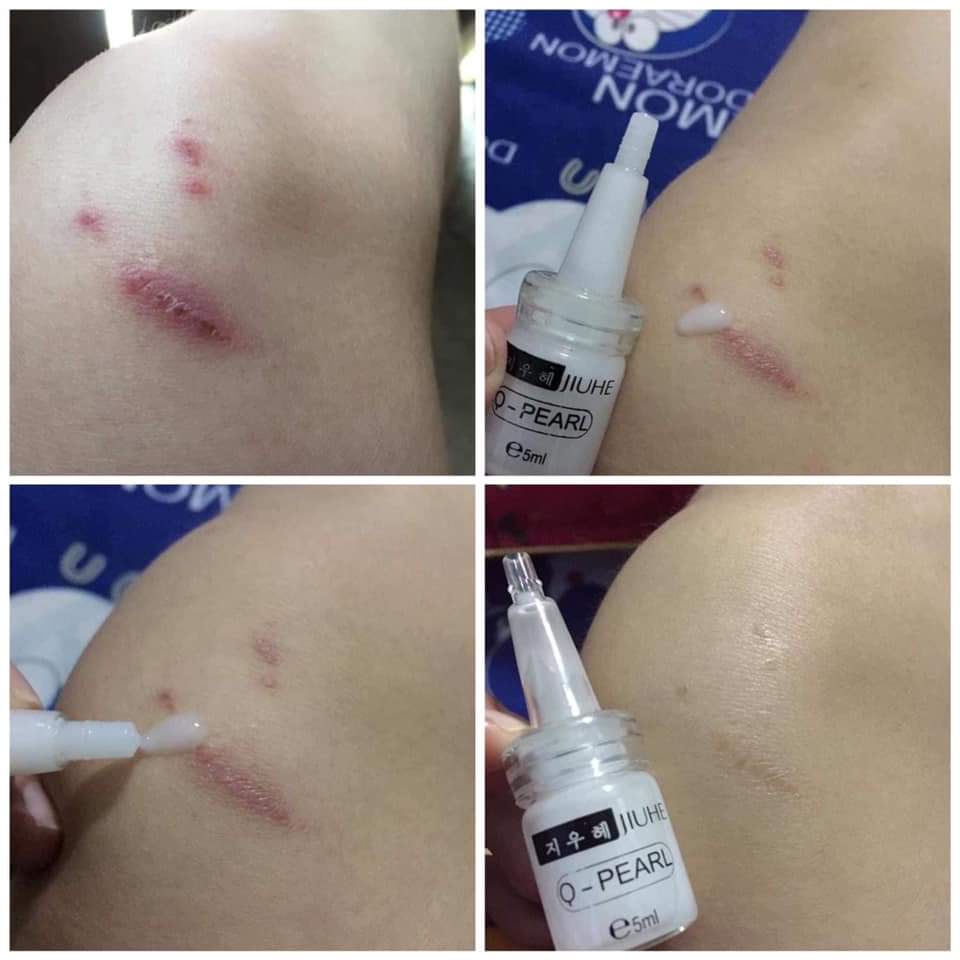 SERUM TRI THÂM JUHE HÀN QUỐC.