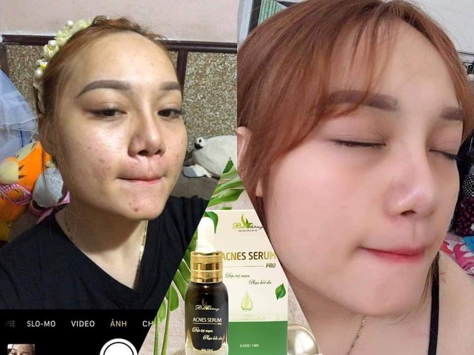 SERUM ACNES NGỪA MỤN THẢO DƯỢC