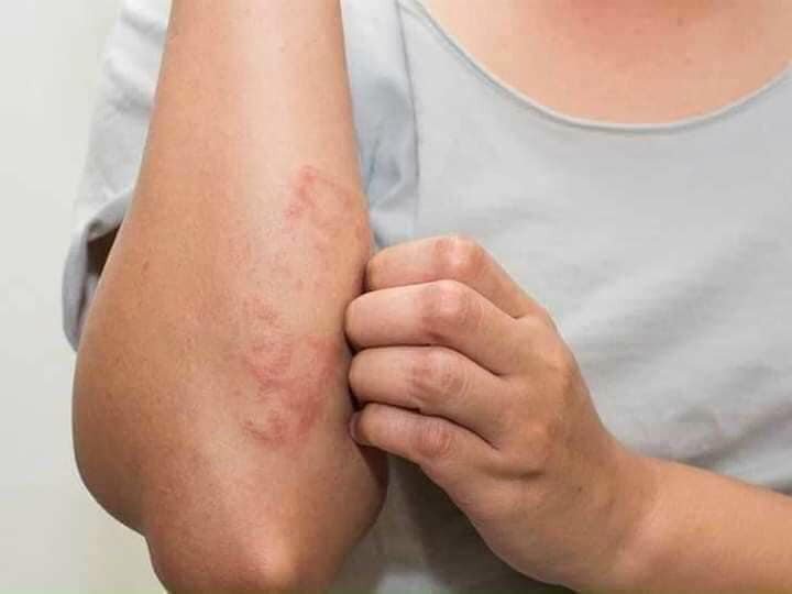 { HÀNG XÁCH TAY NGA CHÍNH HÃNG } - Kem bôi ngứa belosalic
