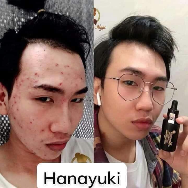 Serum Trị Mụn Hanayuki - Hana Acnes