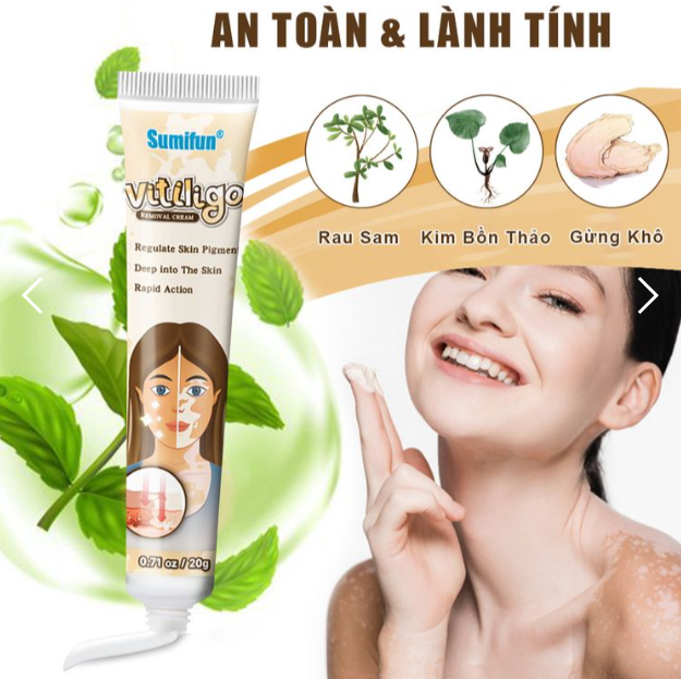 Kem lang ben thảo mộc VITILIGO