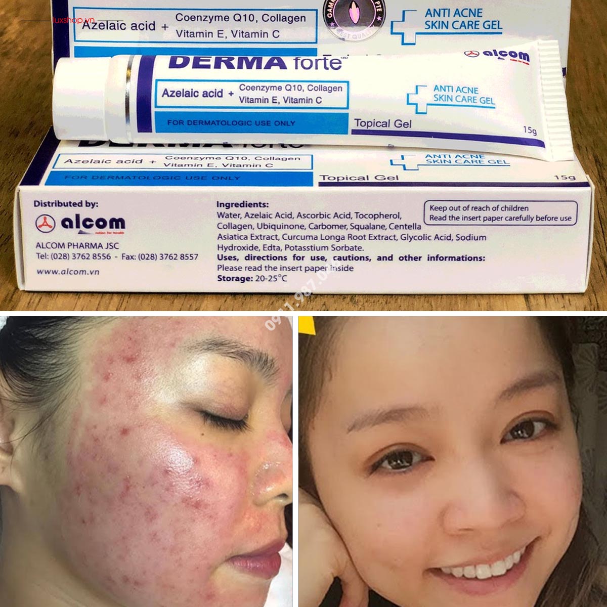 DERMA FORTE KEM MỤN CHĂM SÓC DA 15G