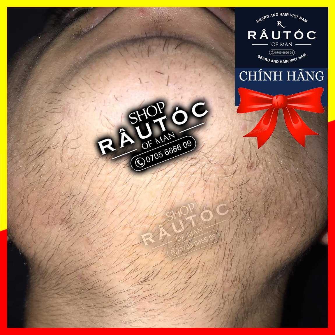 [HCM]RETINOL mix vào Minoxidil hỗ trợ mọc râu tóc