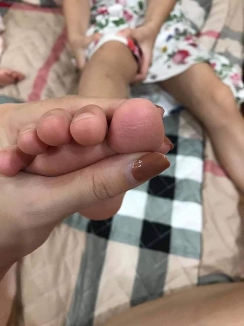 KEM BÔI Á SỪNG
