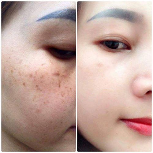 Kem nám tàn nhang cặp Collagen Plus Vit E