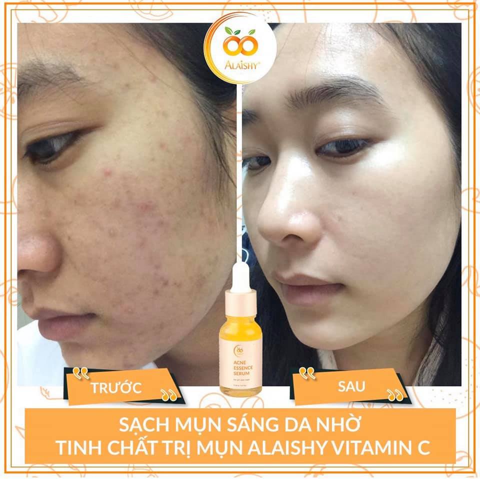 SERUM MỤN ALAISHY VITAMIN C - TINH CHẤT NGHỆ