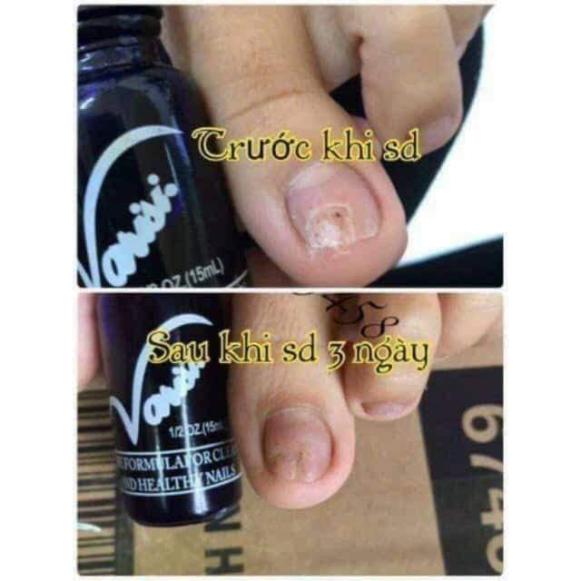 Serum Loại Bỏ Nấm Móng Varisi Restore Problem Nails