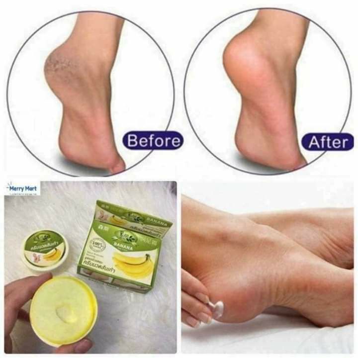 Kem Chuối "Xóa Rạn Nứt Gót Chân" - Thái