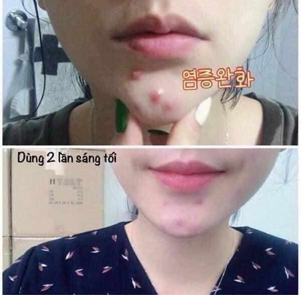 GEL TRỊ MỤN NHẬT BẢN 𝐒𝐀𝐓𝐎 𝐃𝐀𝐋𝐀𝐂𝐈𝐍 𝐓 𝐆𝐄𝐋 1%