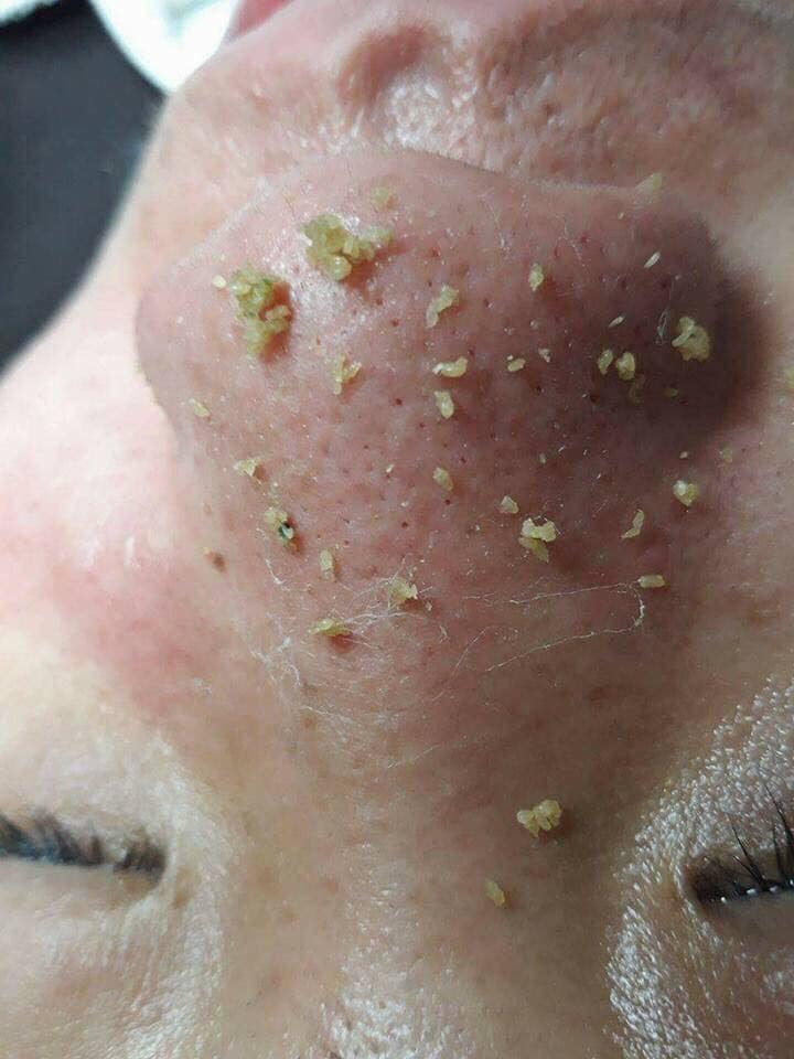 Ủ mụn đầu đen, mụn cám YOUNGER