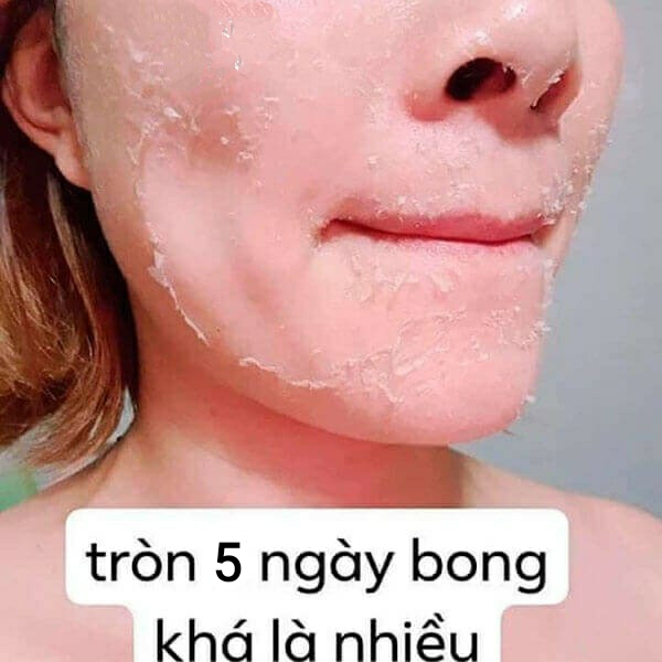 Kem BEZY Bong Da Mặt Xóa Thâm Nám Sạm Trắng Da ( Bong nhanh sau 5 ngày)
