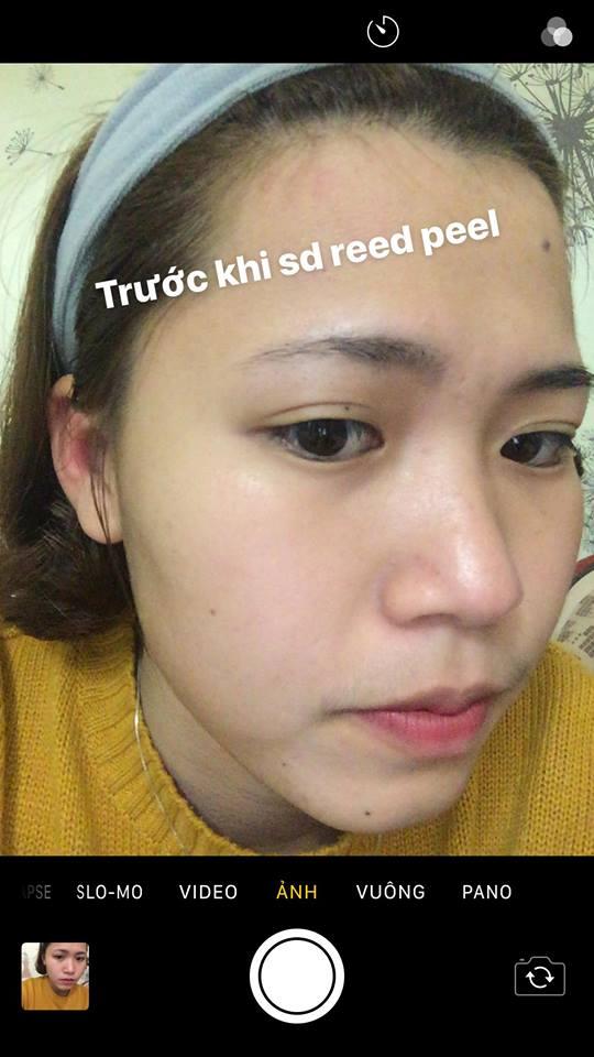 Tinh Chất Thay Da Sinh Học So’Natural Red Peel Tingle Serum