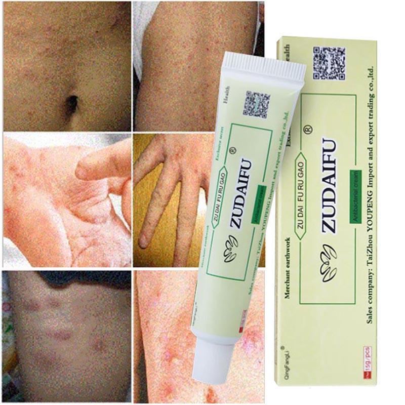 HCMZUDAIFU Natural Chinese Herbal Medicine Cream Eczema Dermatitis