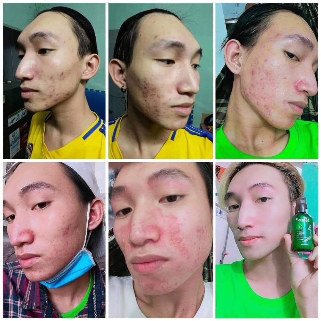 [HCM]Thay da Nhân Sâm MQSKIN