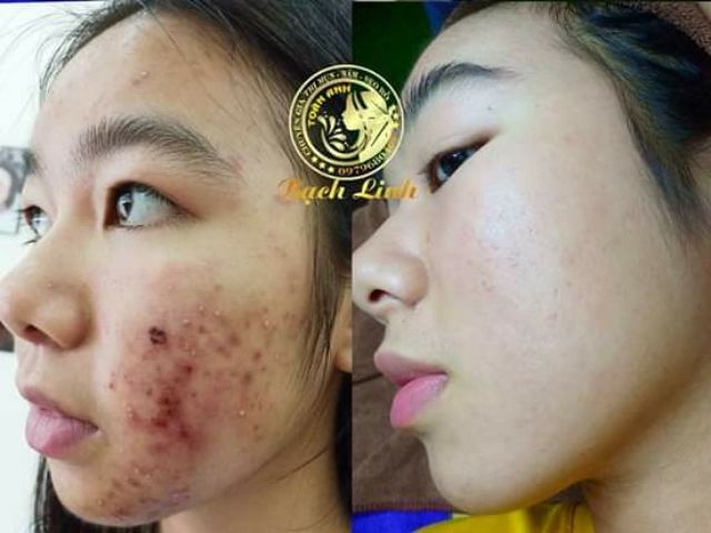 03 plus Bách y Sâm bay mụn, nám