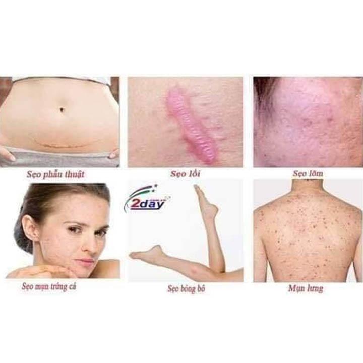 Kem Trị Seo Cao Cấp Nga