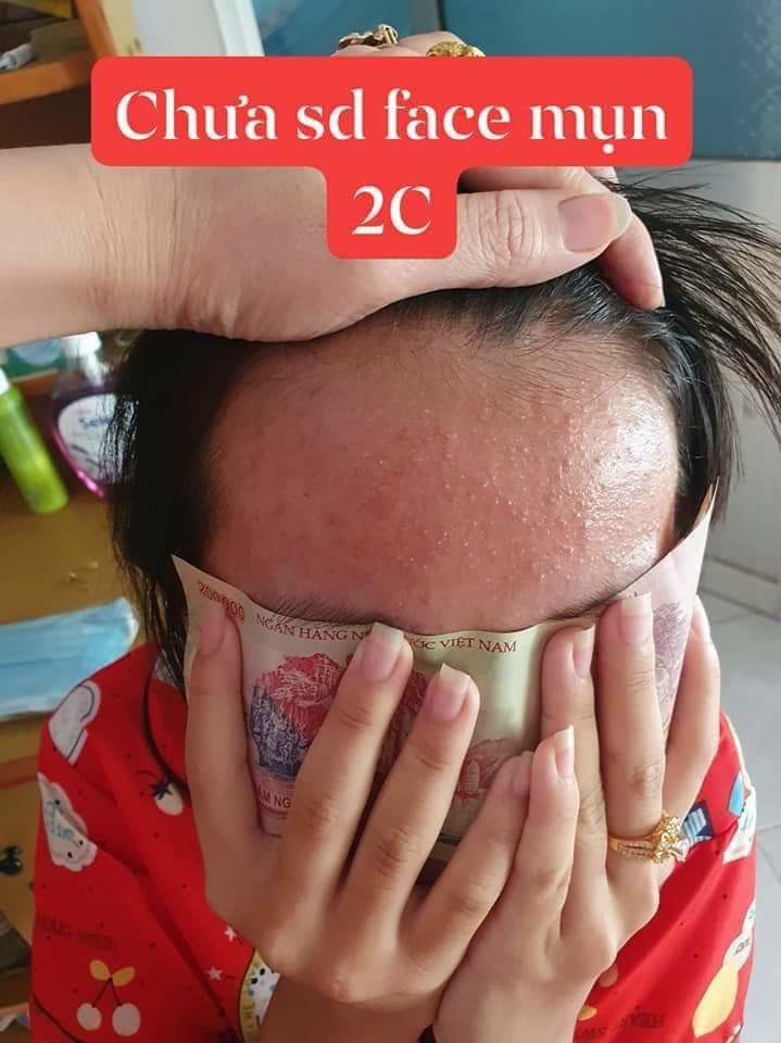 Combo 5 Hộp Kem Mụn 2C