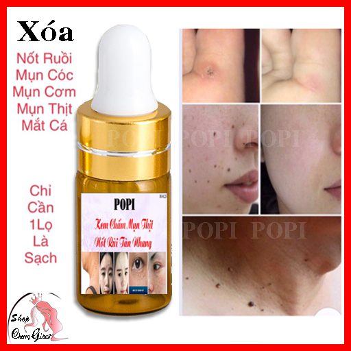 KEM TẨY MỤN CƠM, MỤN CÓC, NỐT RUỒI, MỤN THỊT, TÀN NHANG POPI