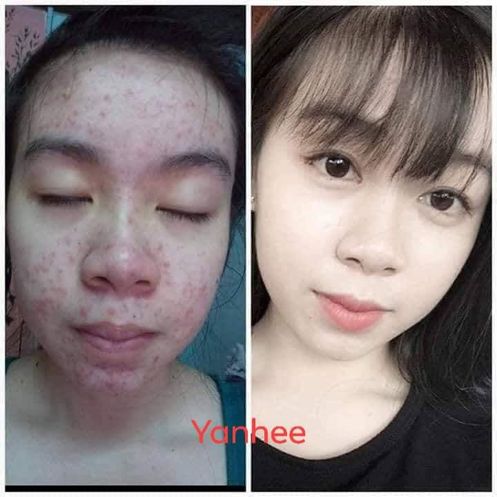 Xà Phòng Ngừa Mụn YANHEE -- Thái Lan