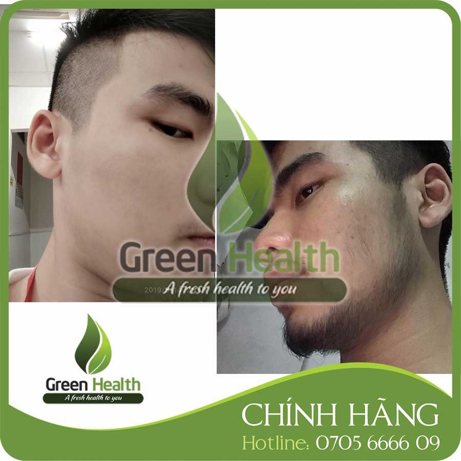 ⊙❣┇ Hộp 6 chai mọc râu tóc Minoxidil 5 dạng lỏng