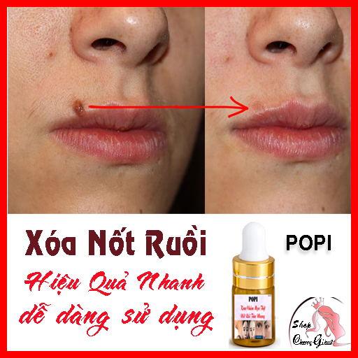 KEM TẨY MỤN CƠM, MỤN CÓC, NỐT RUỒI, MỤN THỊT, TÀN NHANG POPI