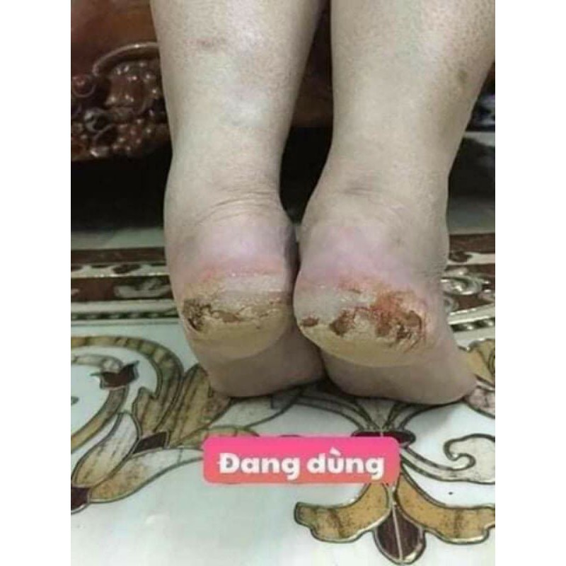 THẢO MỘC BÔI DA THIÊN NHIÊN TKH