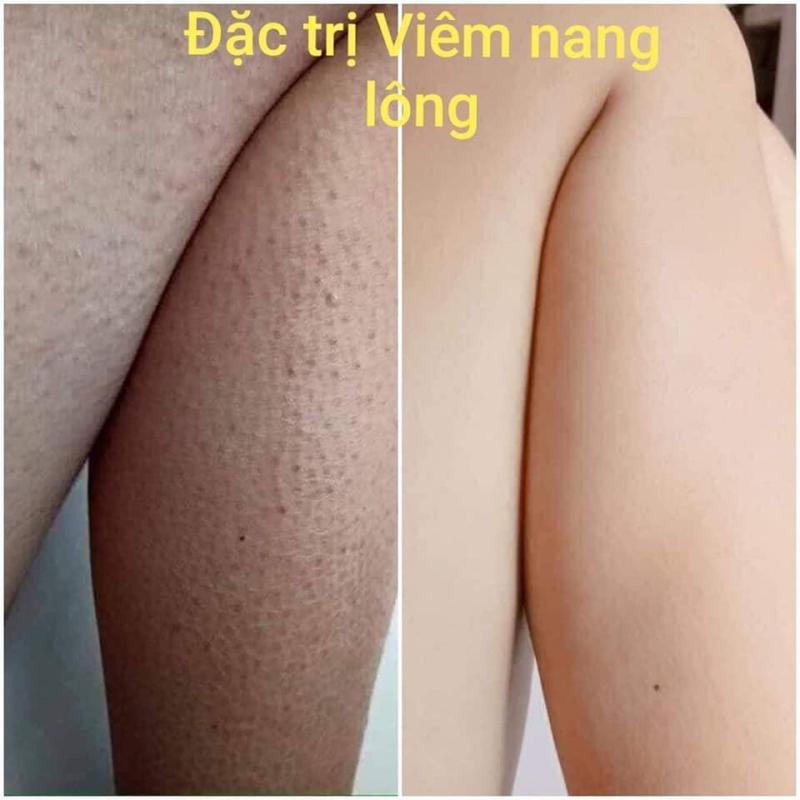 ĐẶC TRỊ VIÊM NANG LÔNG, MỤN LƯNG