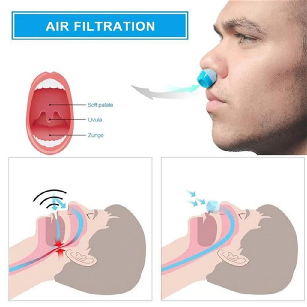 Thiết bị chống ngáy chống nghẹt mũi chống ngáy