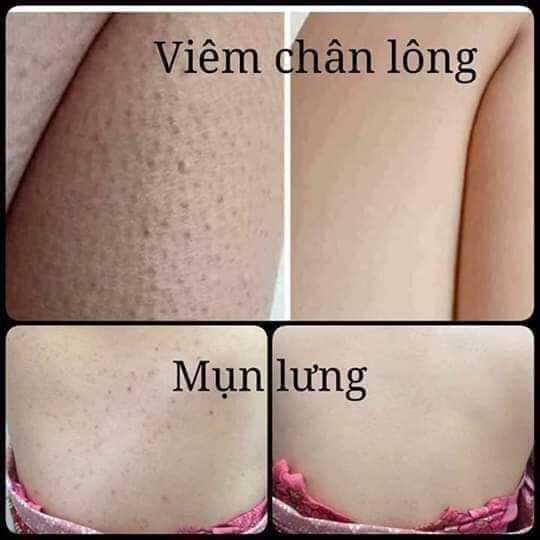 Combo lớn Tắm men bia + Kem Multi 16 Athena 30g