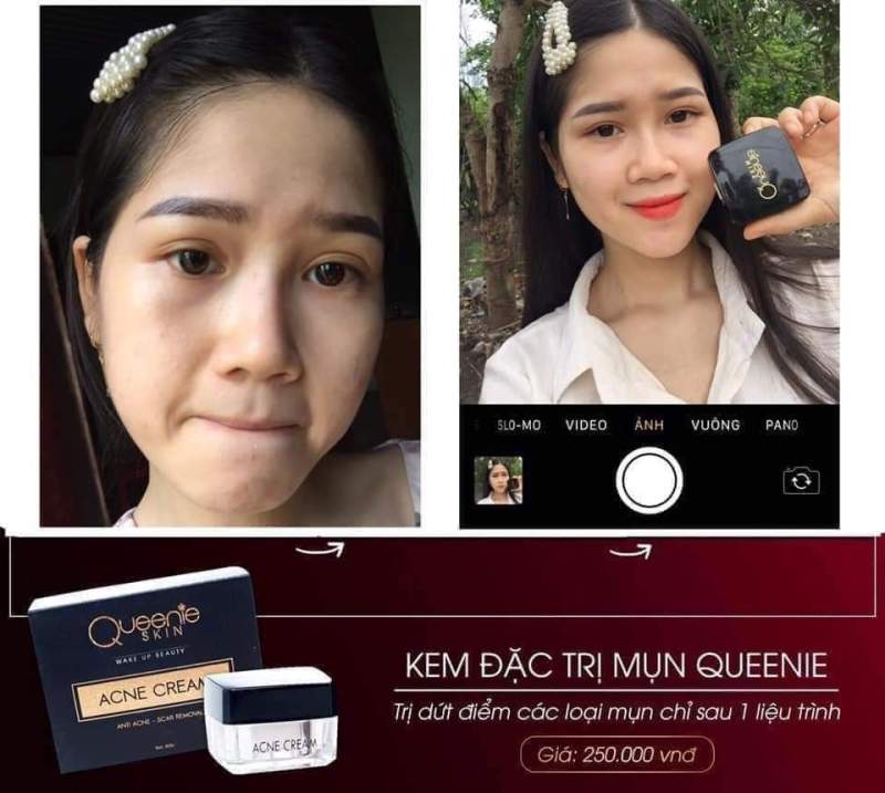 KEM  MỤN QUEENIE SKIN cao cấp