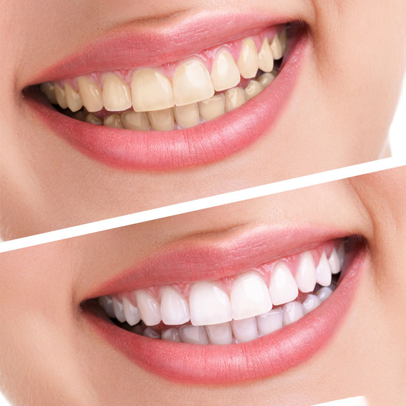 Đánh răng trắng tự nhiên không ê buốt, loại bỏ mảng bám và cao răng