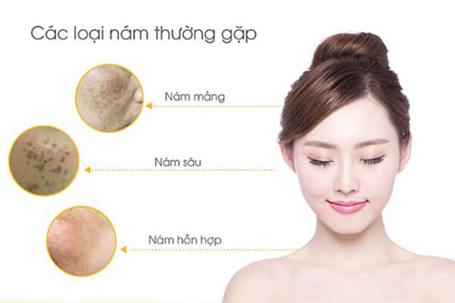 [HCM]Kem giảm mụn cấp tốc ZA cream 10g