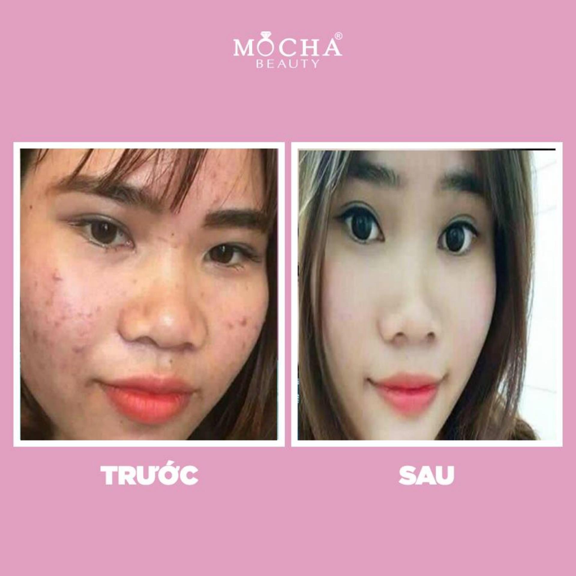 Kem Mụn - Bộ MỤN MOCHA 60gram gồm 2 hộp